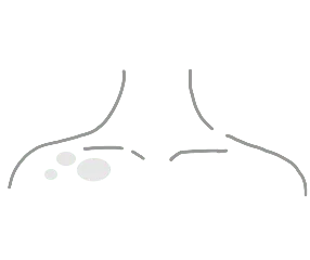 Vitiligo