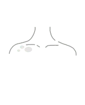 Vitiligo
